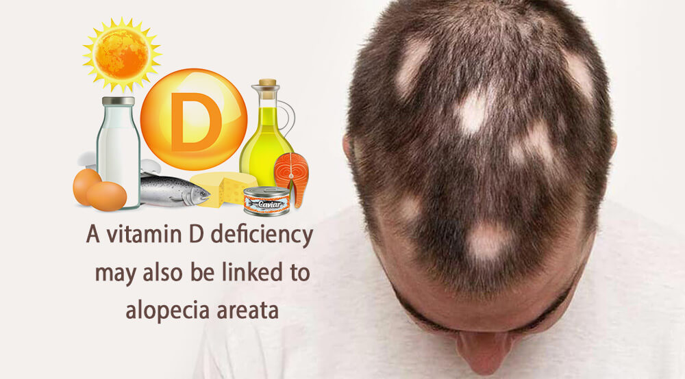 کمبود ویتامین D, ریزش موی سکه ای, آلوپشیا آره آتا, 25-هیدروکسی ویتامین D, مکمل های دارویی ویتامین دی, تلوژن افلوویوم, سومین شکل رایج ریزش مو .